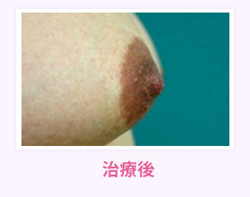 治療後