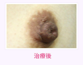 治療後
