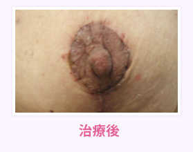治療後