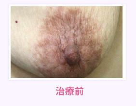 治療前
