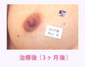 治療後