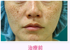 治療前