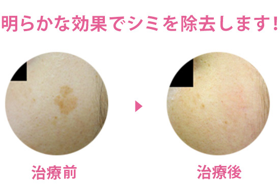 明らかな効果でシミを除去します！