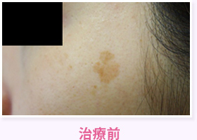 治療前