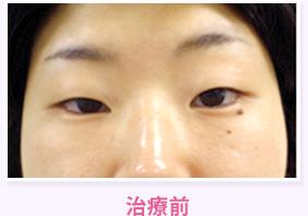 治療前