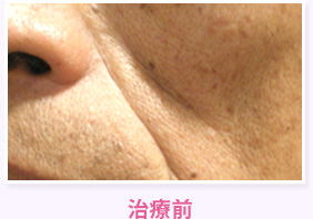 治療前