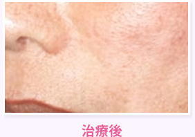 治療後