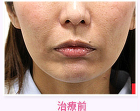 治療前