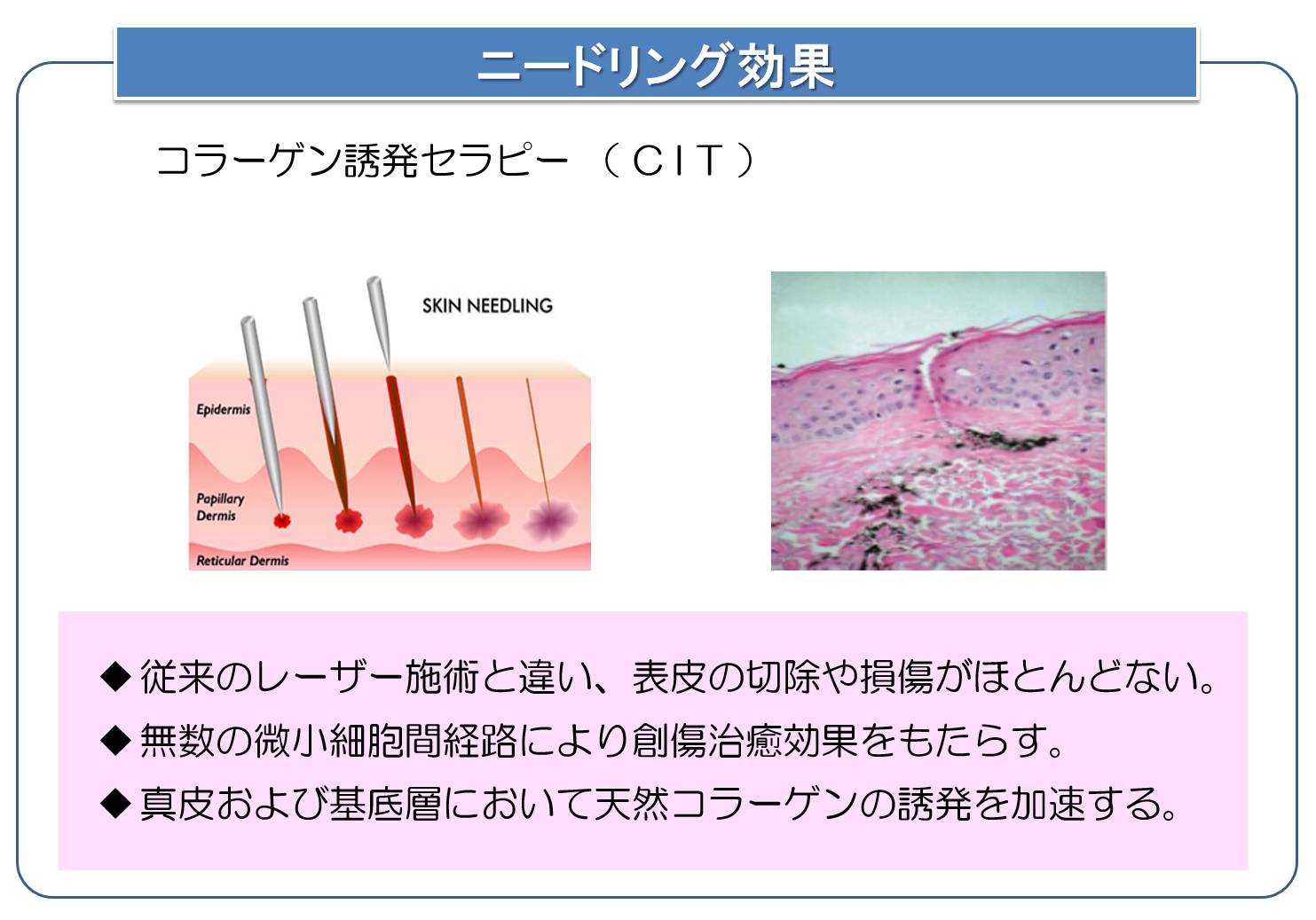 キュットリフトインナーリフト効果