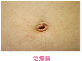 イボ治療前
