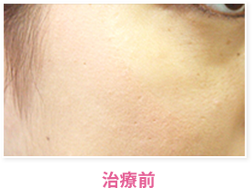 治療前