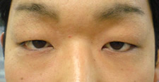 case_eye2_003_p2