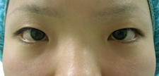 case_eye2_005