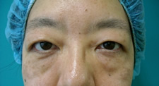 case_eye2_011