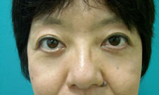 case_eye_010